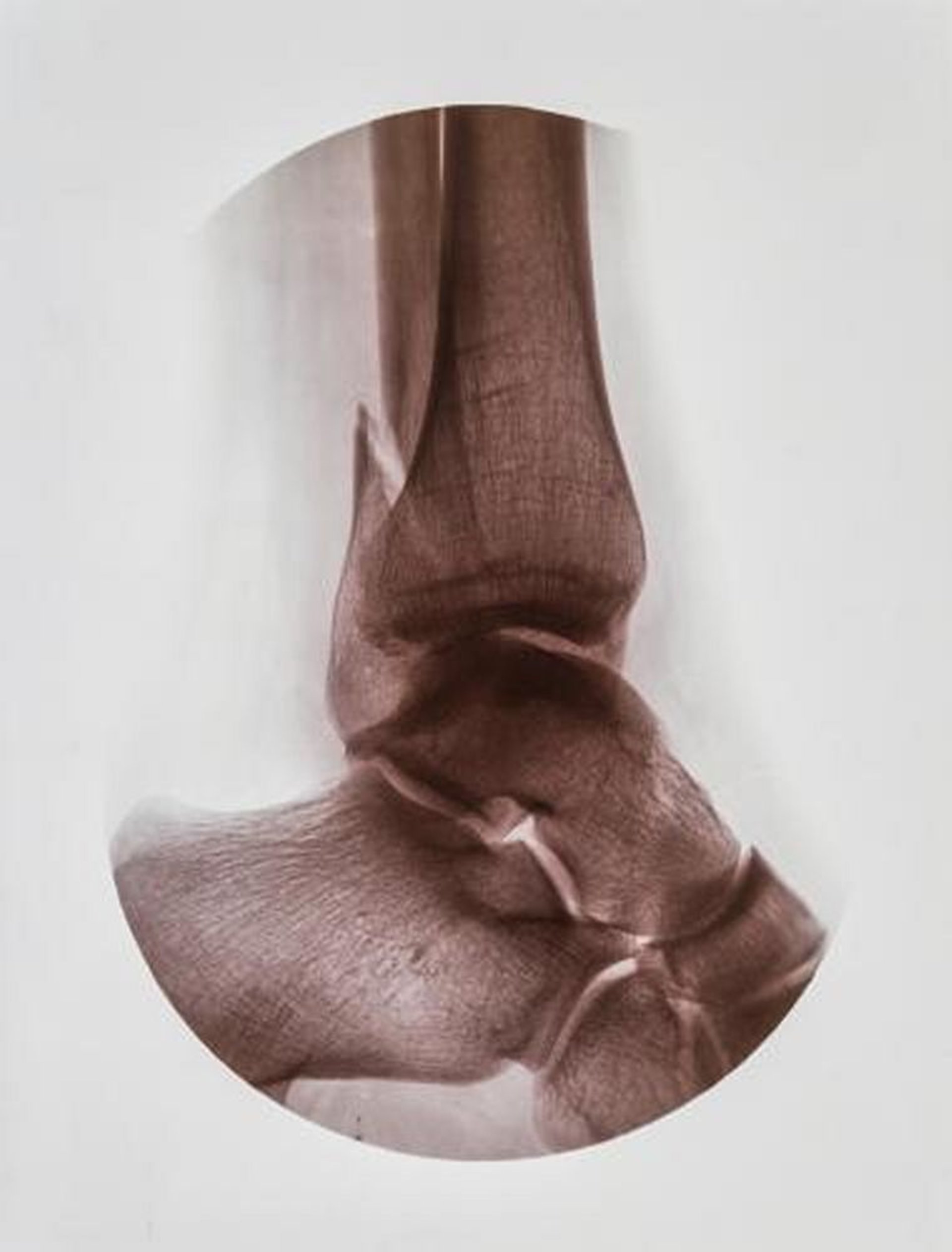 Fractura del tobillo posterior (peroneal)