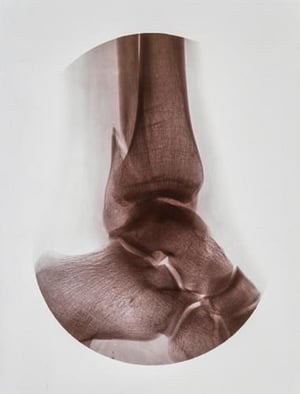 Frattura posteriore (fibulare) della caviglia