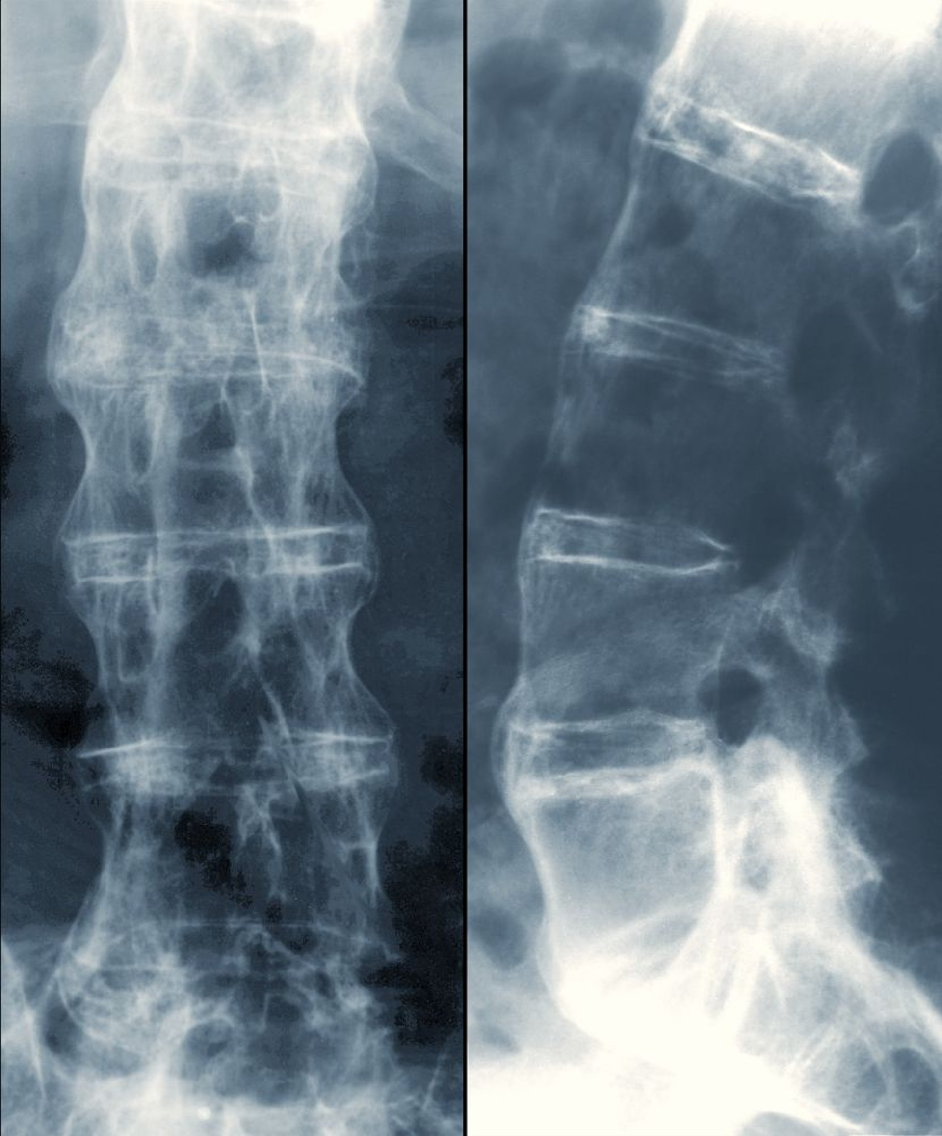 Espondilitis anquilosante (columna vertebral de bambú)