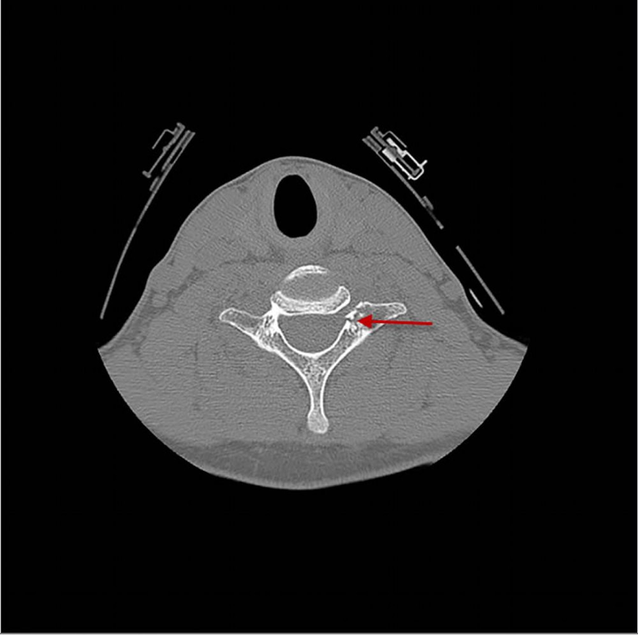 Vértebra cervical fracturada