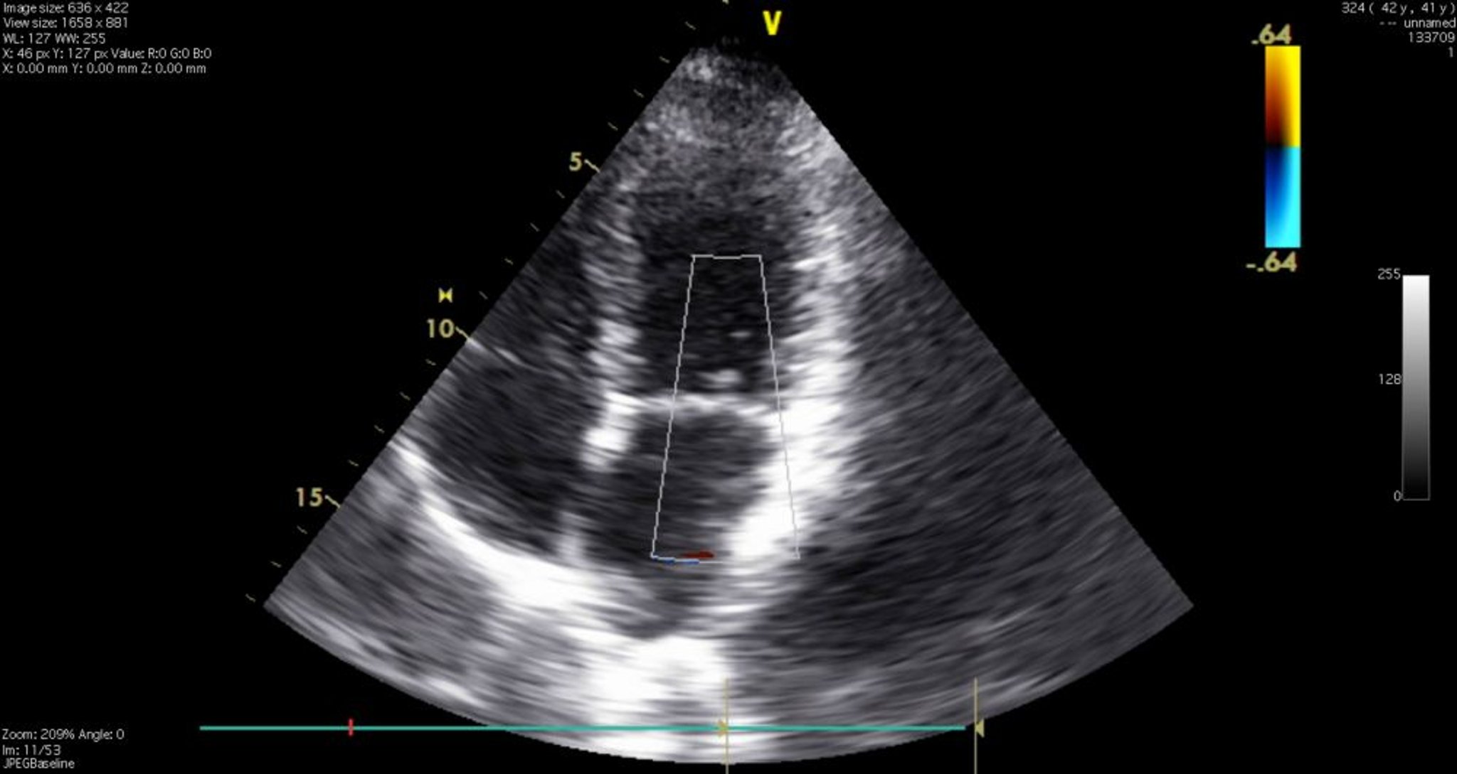 Ecocardiograma (vista de 4 cámaras)