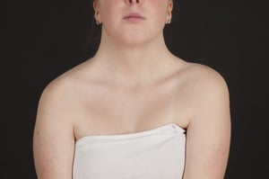 Síndrome de Turner (cuello corto y grueso)