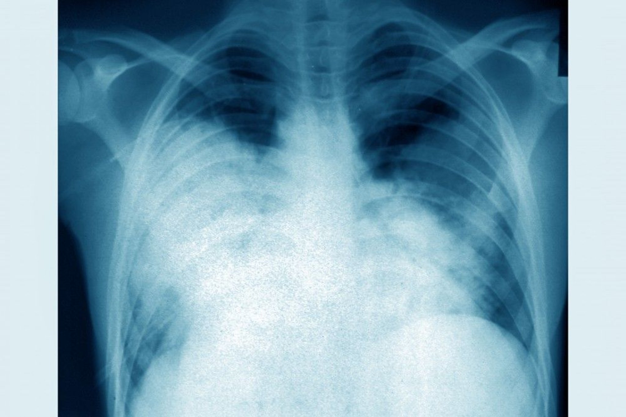 Legionnaire's Disease (Chest X-Ray)