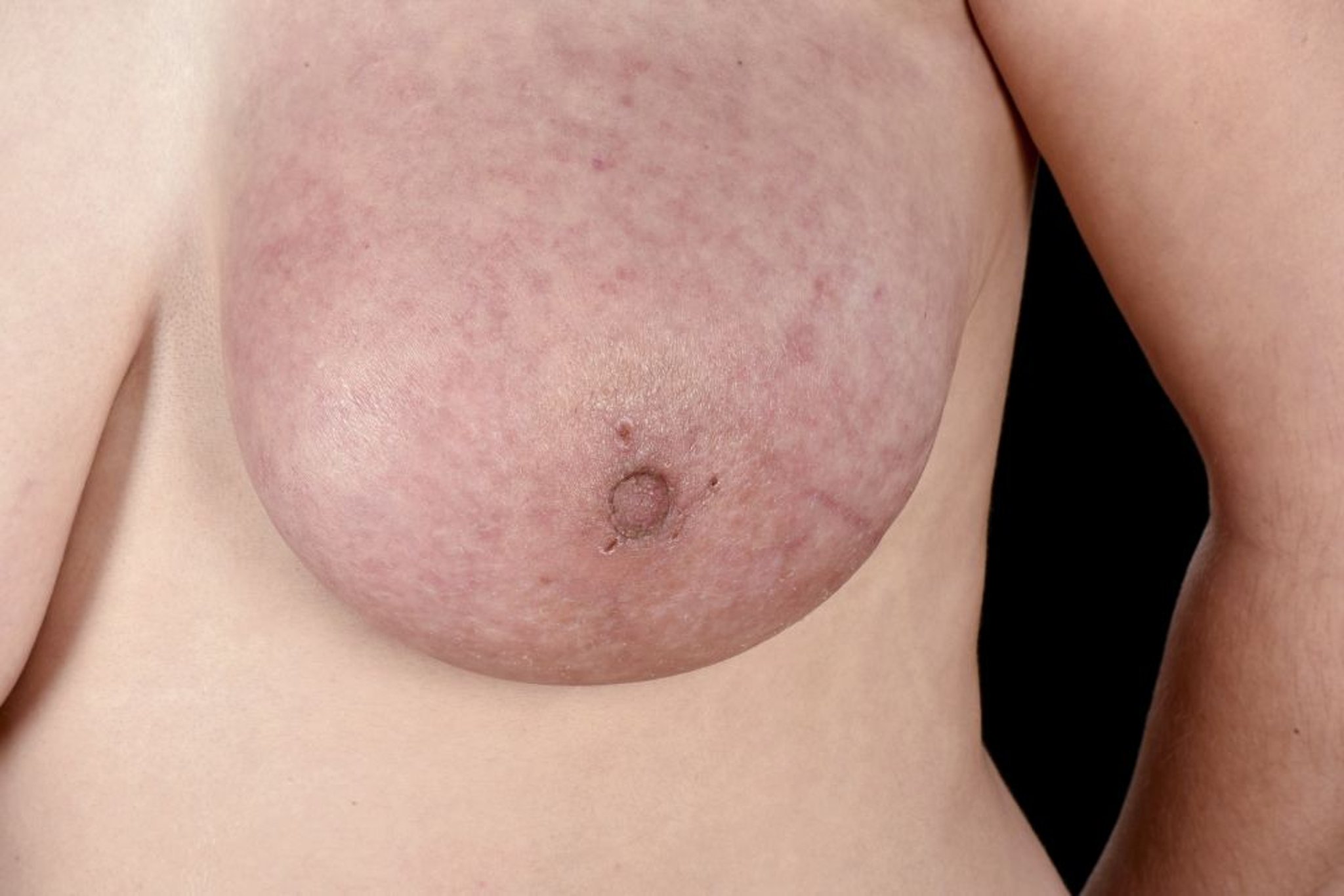 Cancro al seno infiammatorio
