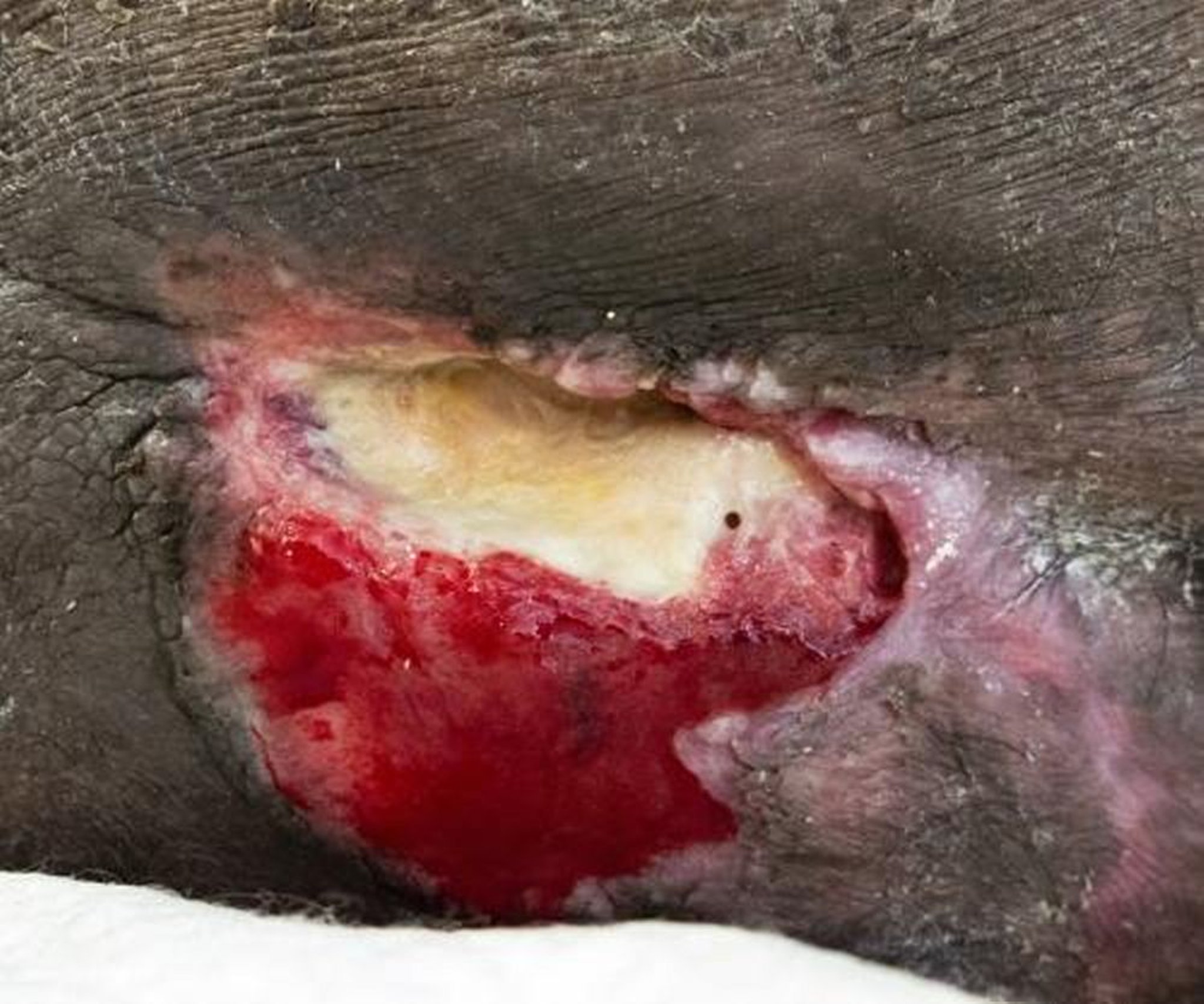 Lesão por pressão, estágio 3 (base da coluna vertebral)