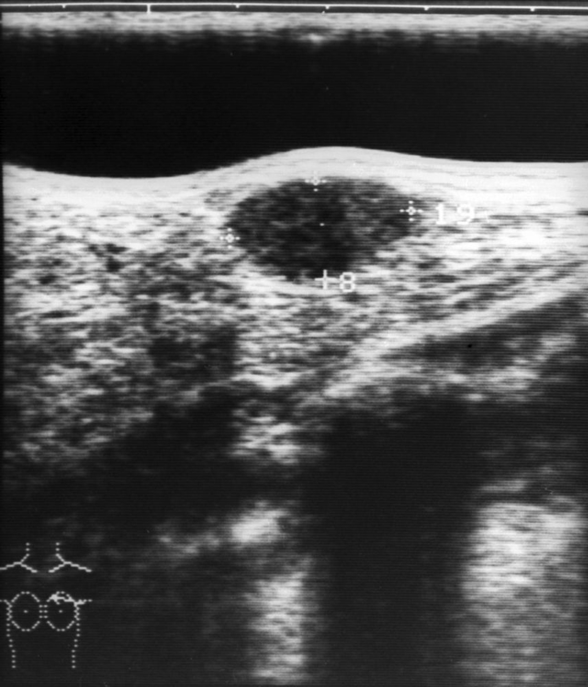 Ultrassom de nódulo mamário