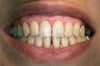 Relatively Healthy Gums and Teeth