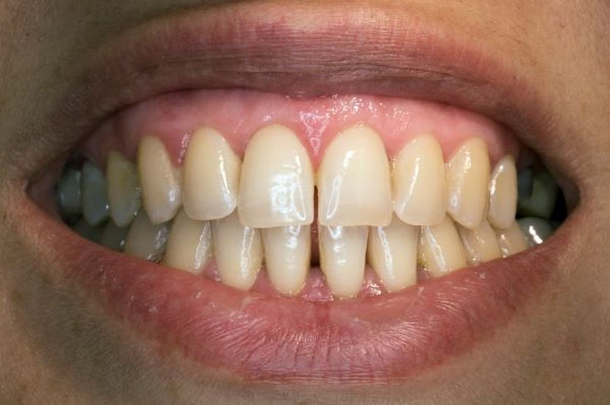 Dentes e gengivas relativamente saudáveis