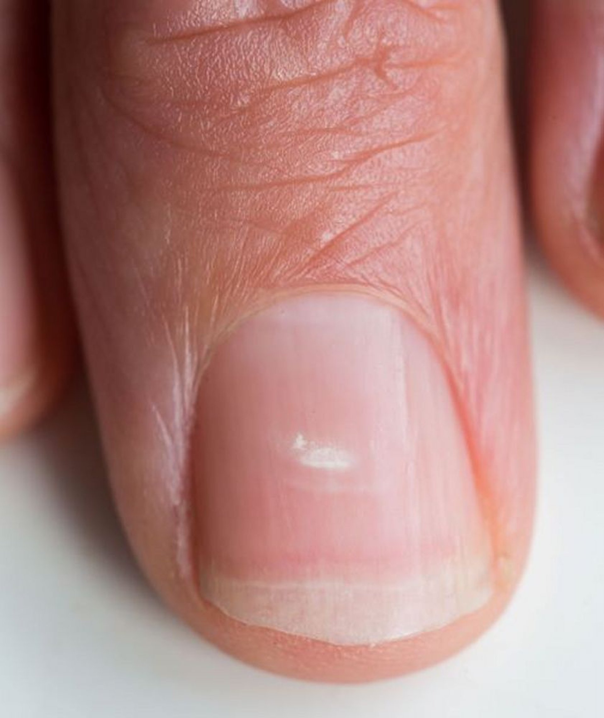 Tache blanche sur l'ongle