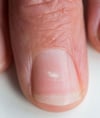 Белое пятно на ногте Белое пятно на ногте