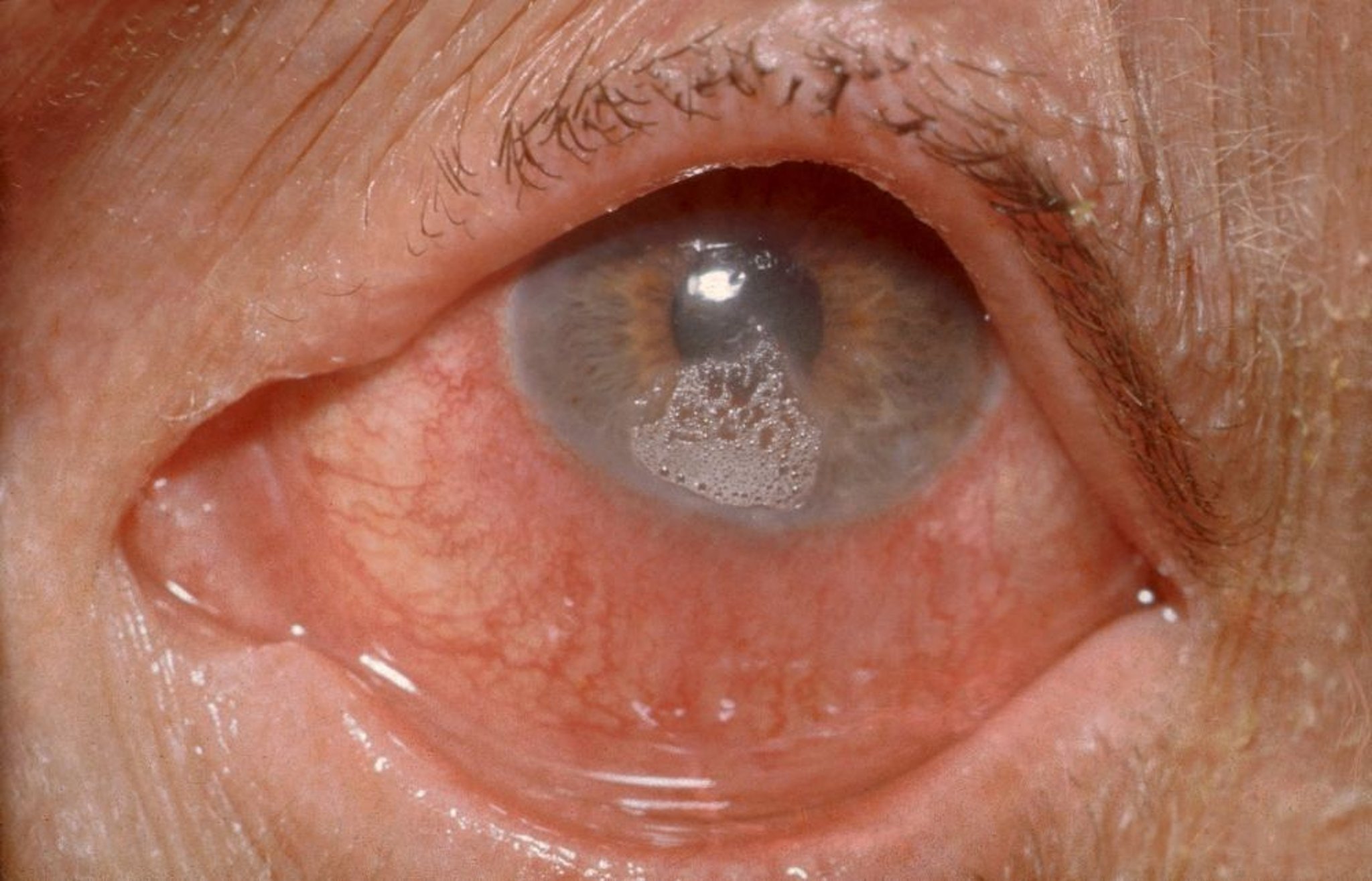 Quemadura ocular (química)