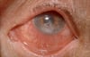 Queimadura ocular (química)