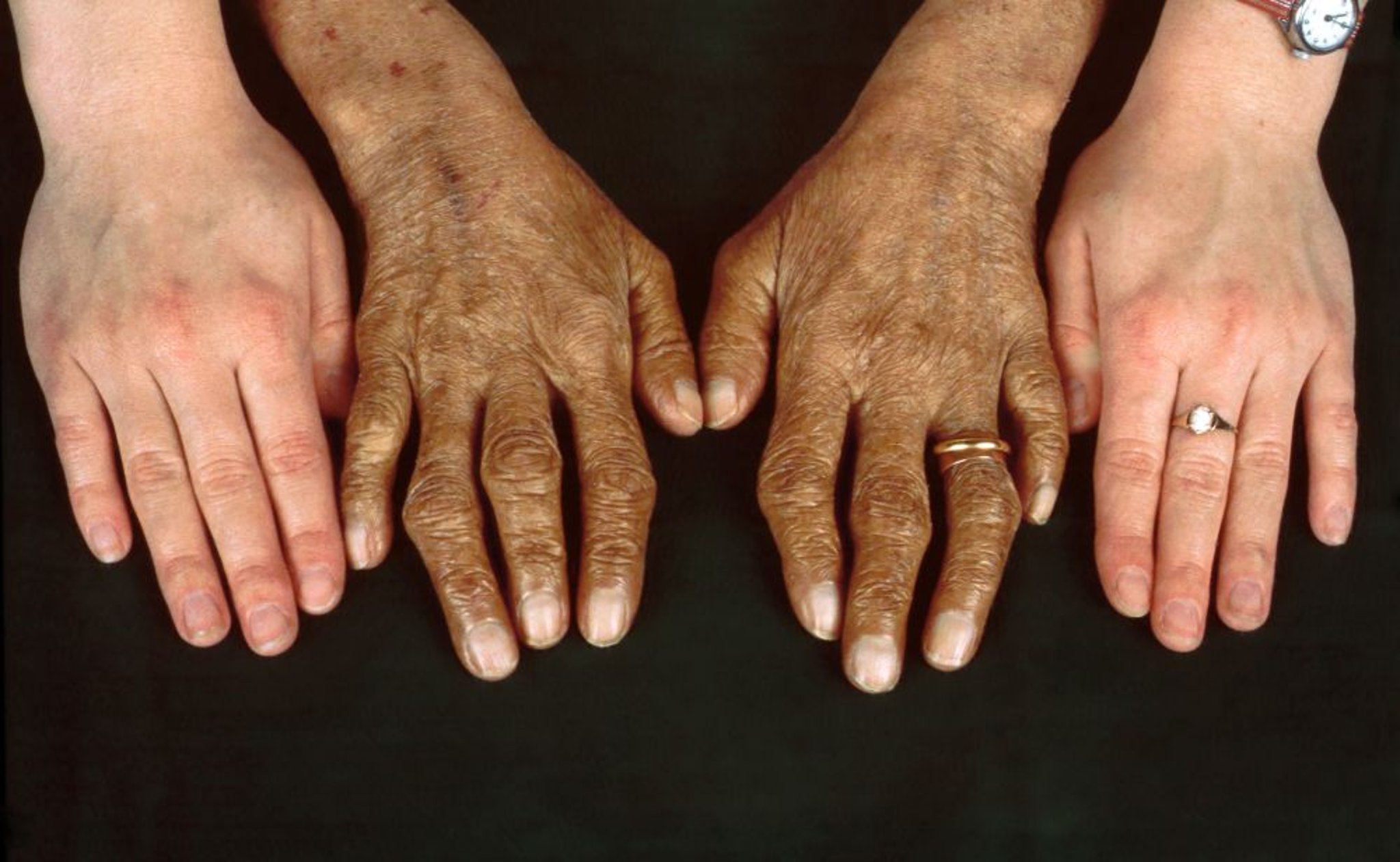 Hemochromatosis (Skin Hyperpigmentation)