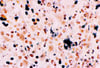 Tinción de Warthin-Starry (Bartonella henselae)