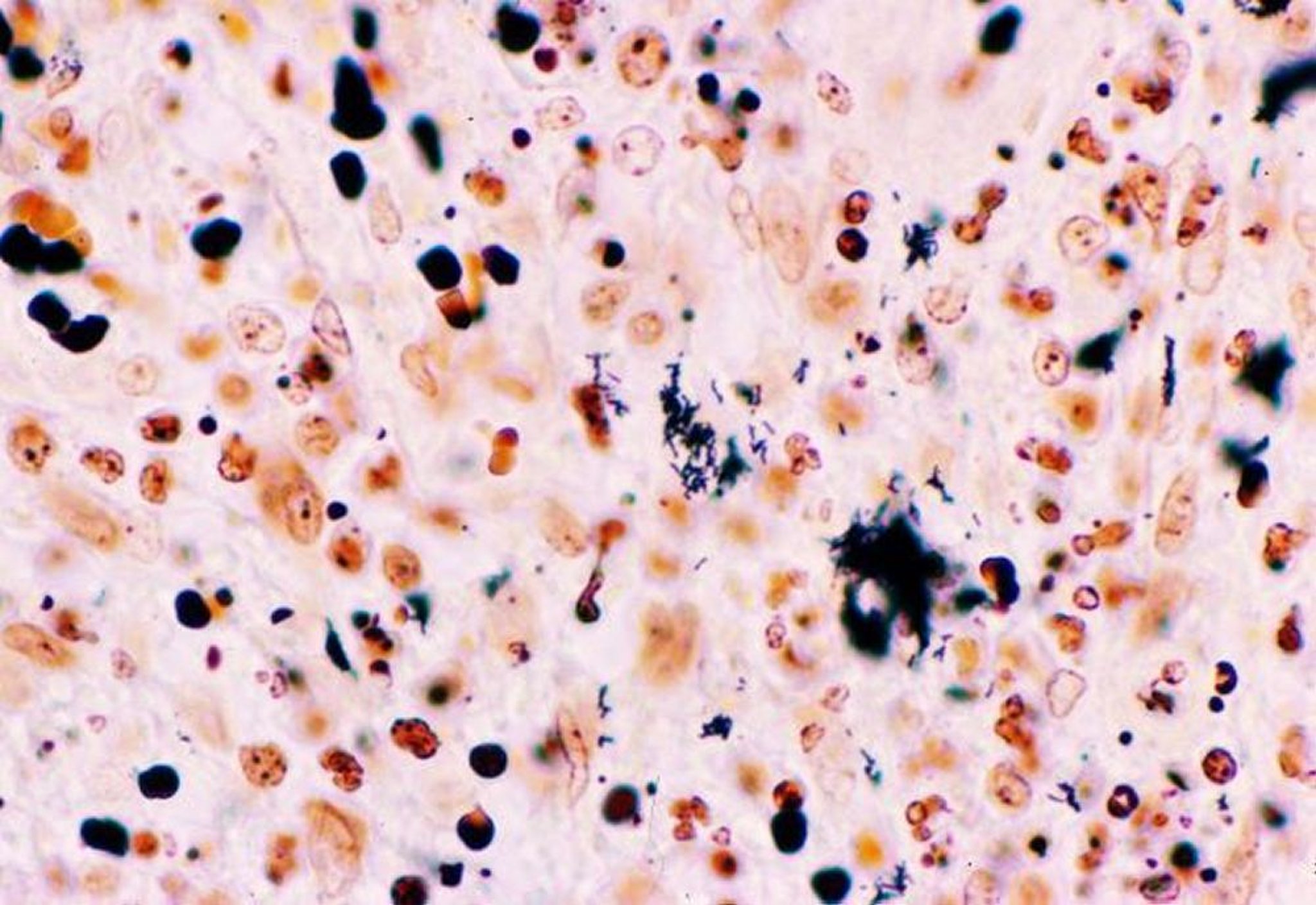 Nhuộm Warthin-Starry (<i >Bartonella henselae</i>)