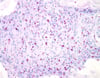 Ziehl-Neelsen Stain (Mycobacterium leprae)