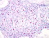 Tinción de Ziehl-Neelsen (Mycobacterium leprae)