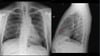 Radiografía de tórax de un paciente después de una cirugía de derivación de la arteria coronaria