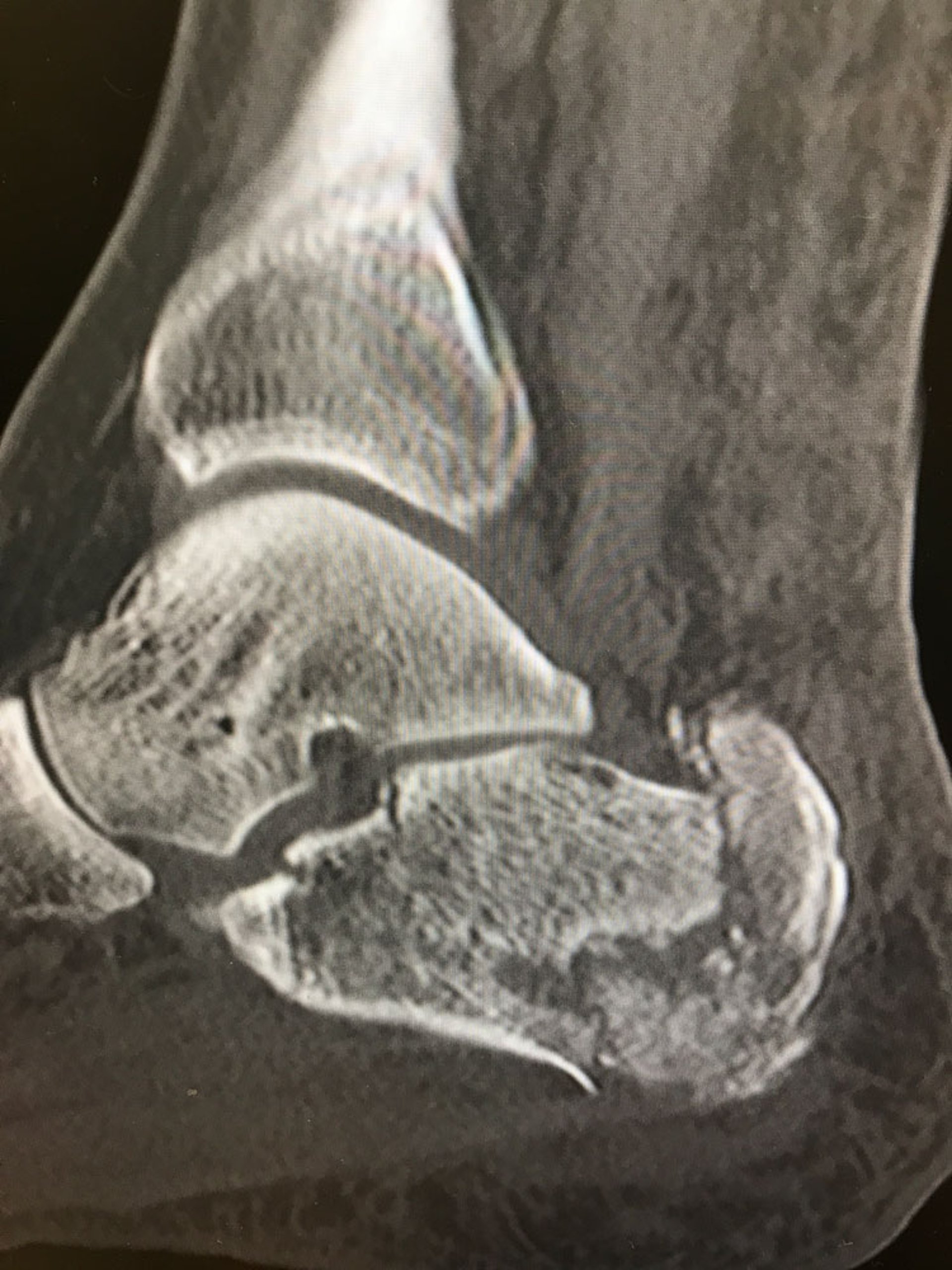 Calcaneal Fracture