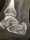 Fracture du calcanéum