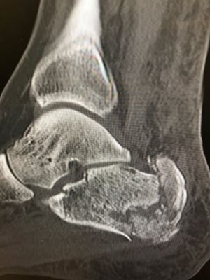 Fracture du calcanéum