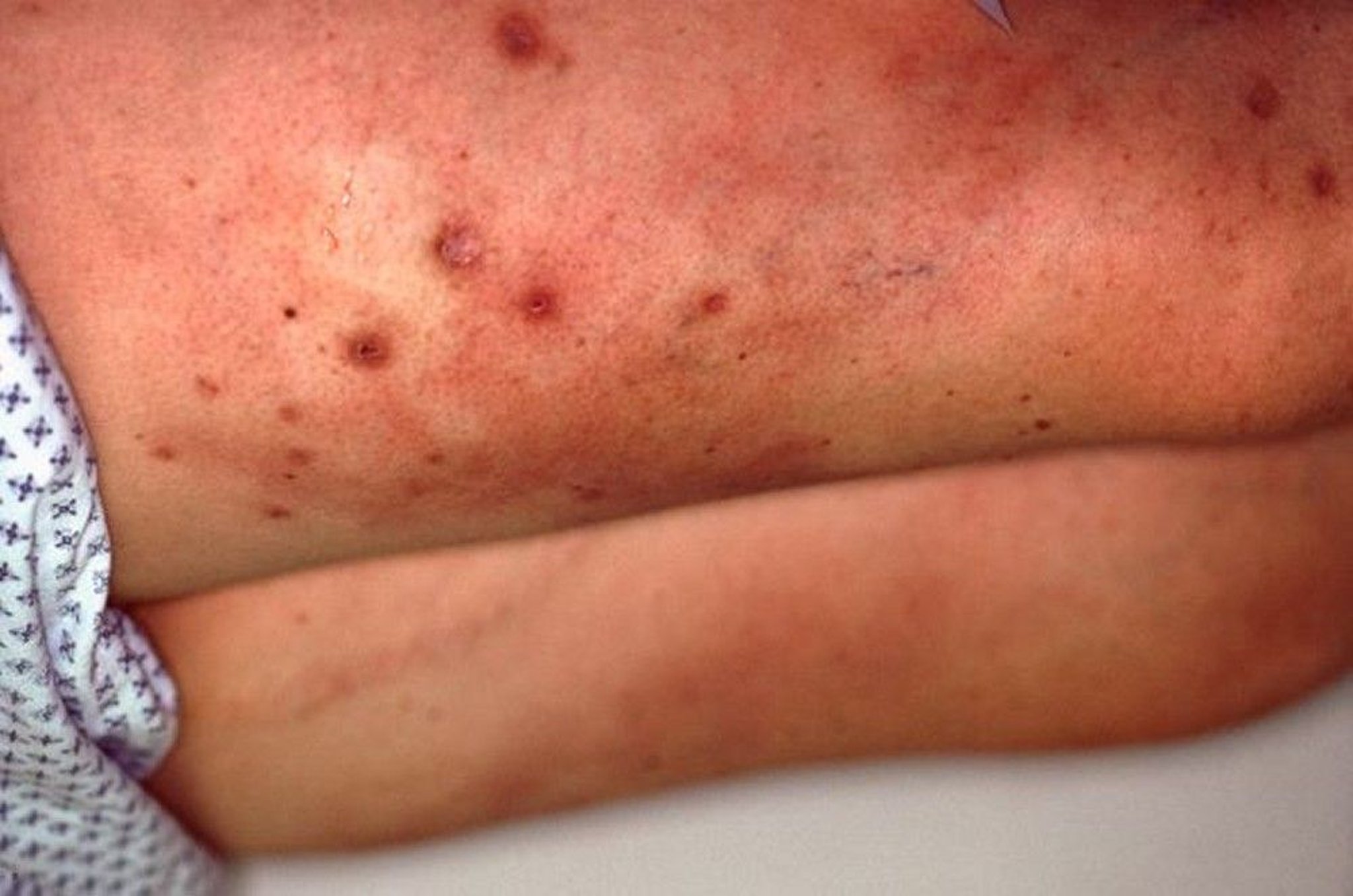 Calciphylaxis (Trunk)