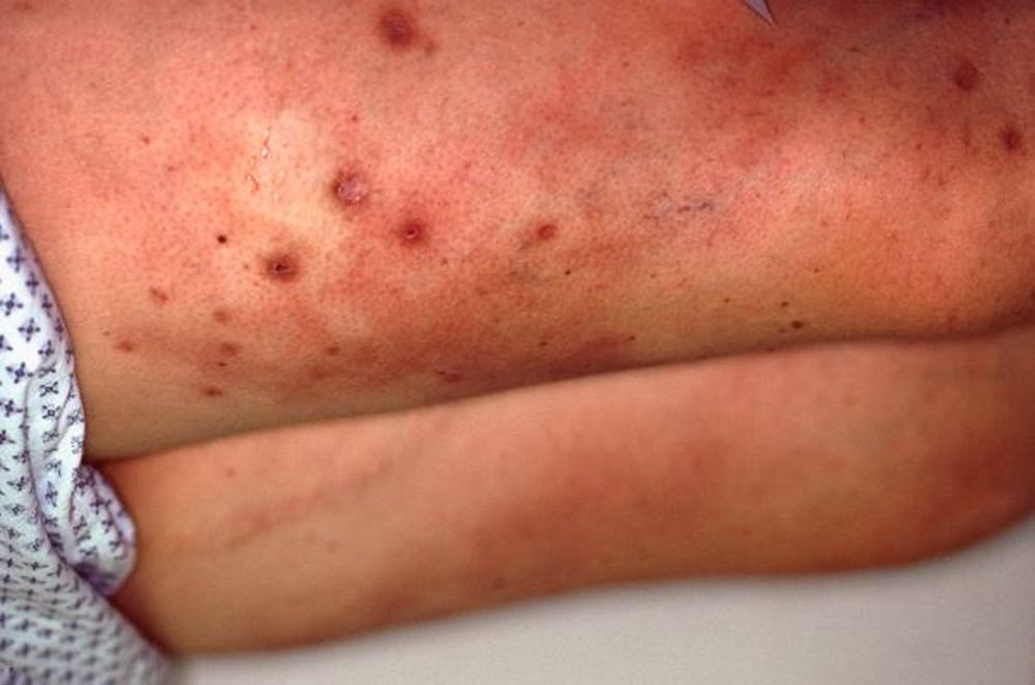 Calciphylaxie (tronc)