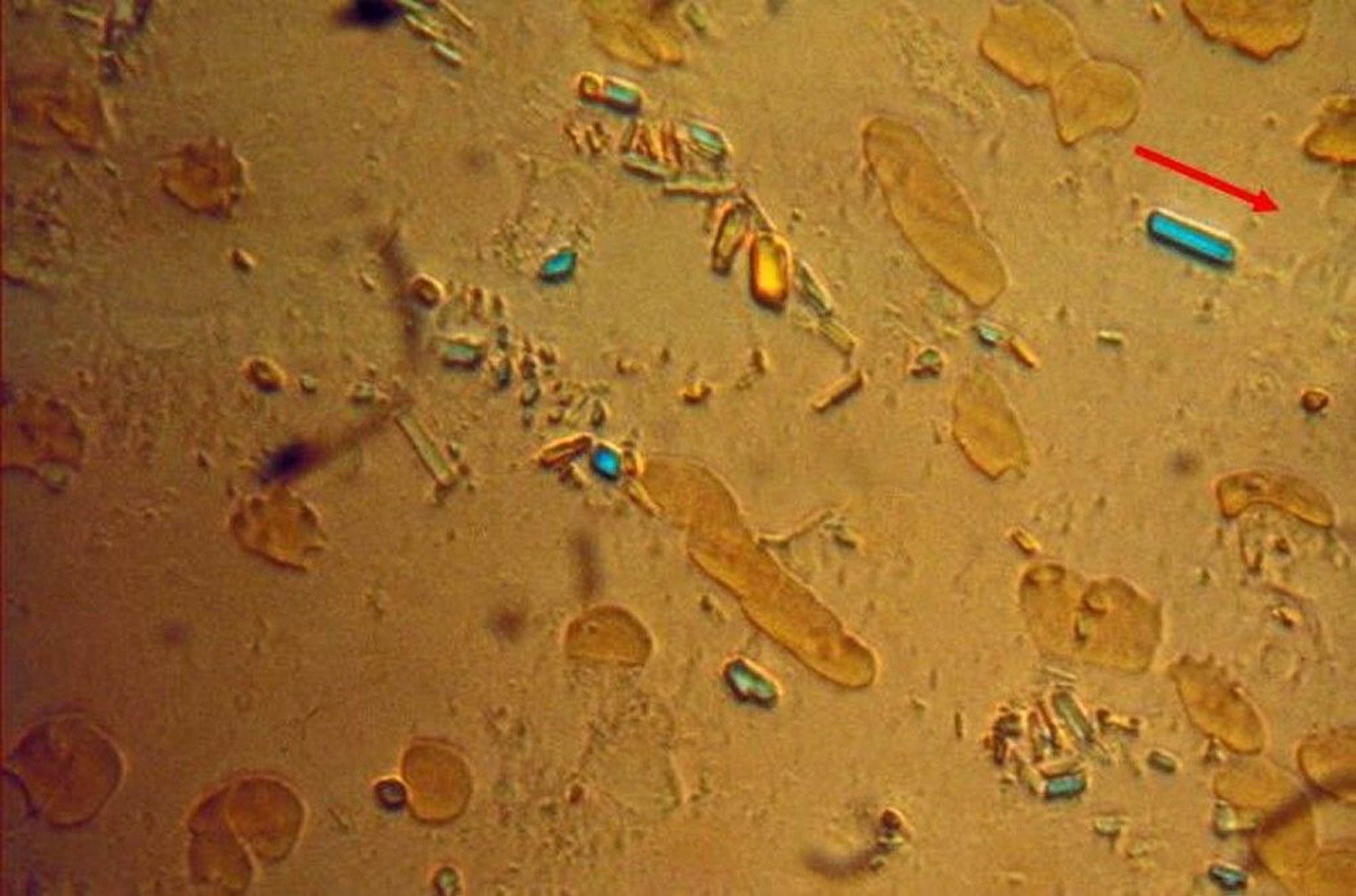 Calcium Pyrophosphate Dihydrate Crystals