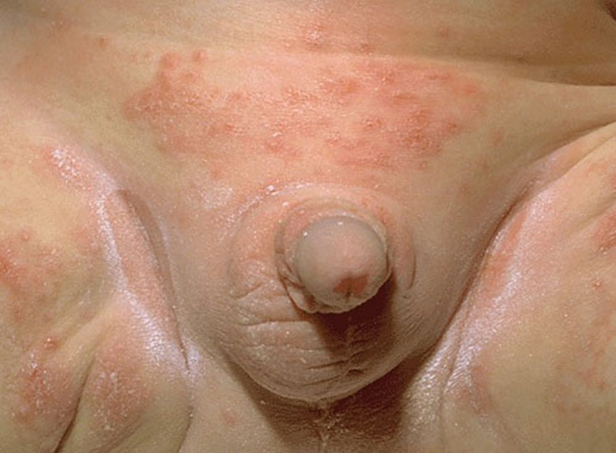 Candidiasis (Diaper Rash)