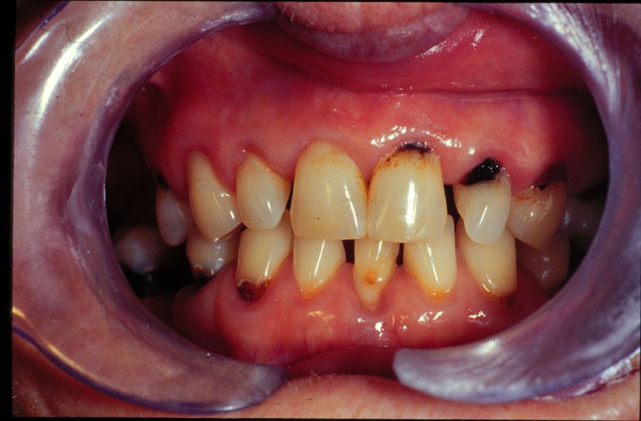Sâu răng (đang khám)