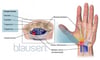 Carpal Tunnel Syndrome