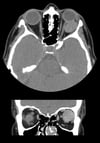 Hemangioma cavernoso