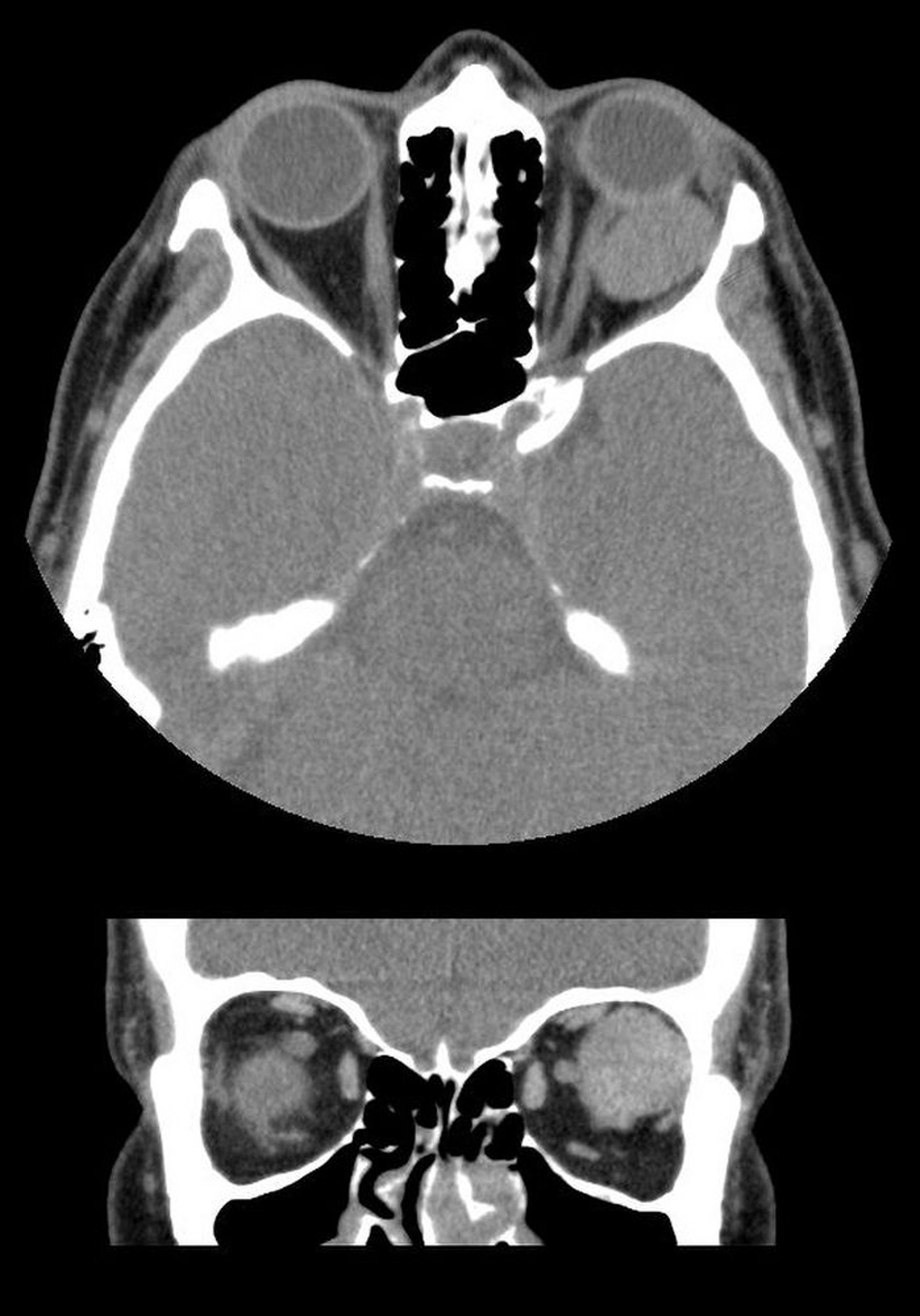 Hemangioma cavernoso