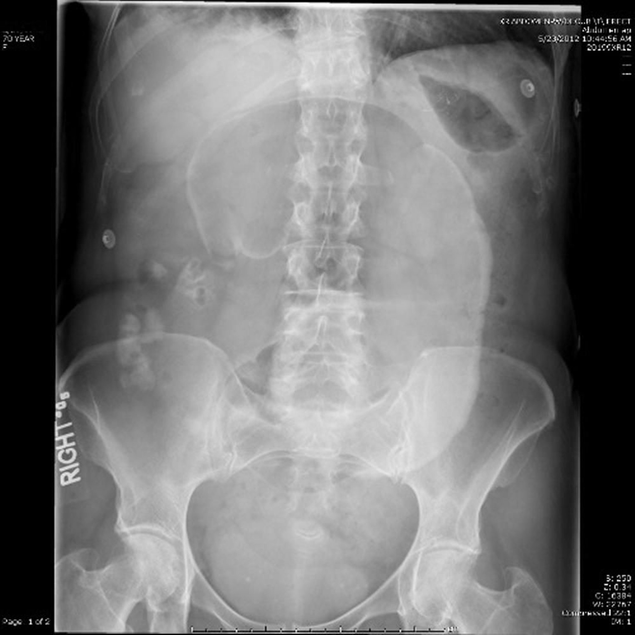 Volvolo cecale (RX addominale)