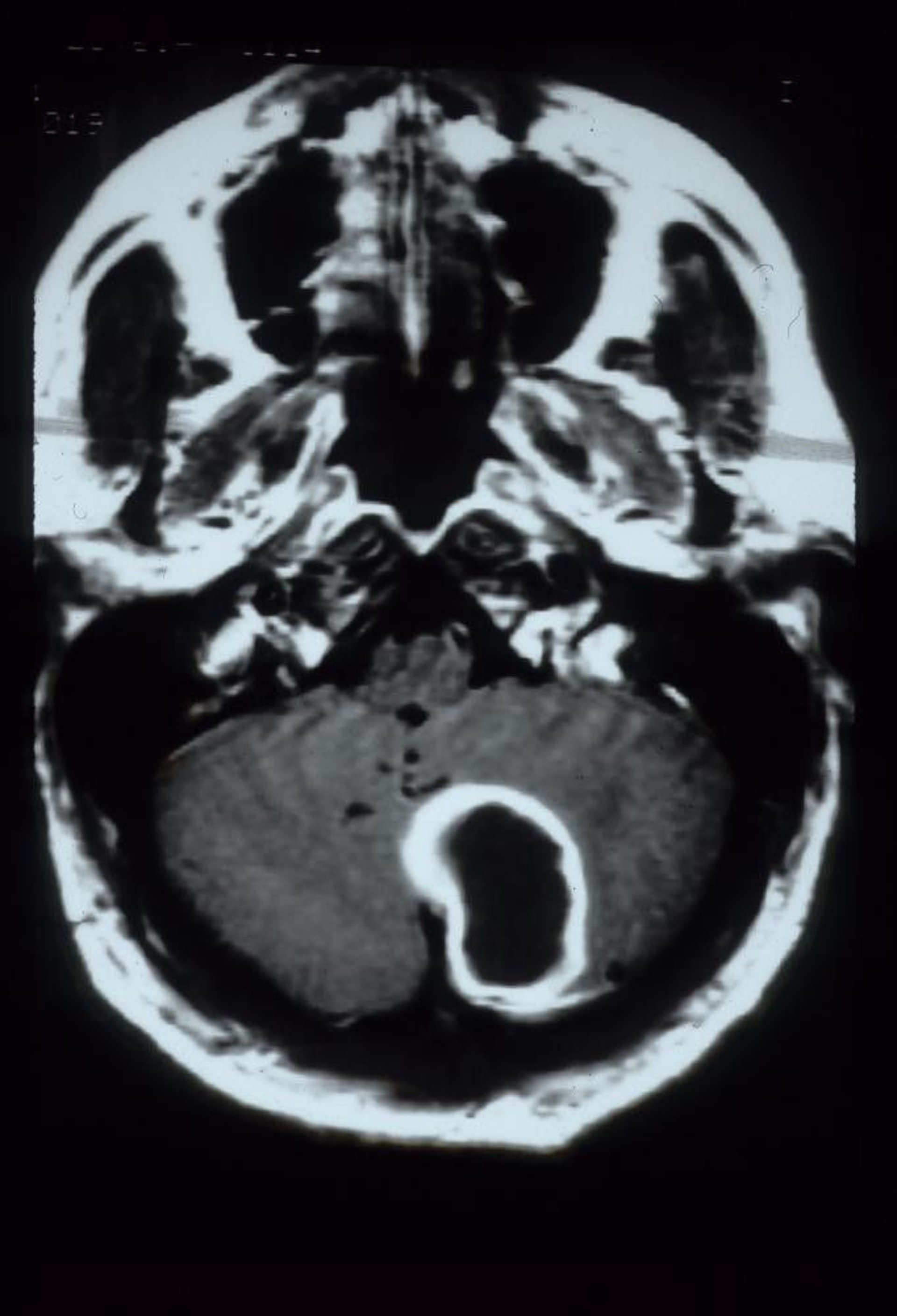 Cerebellar Abscess