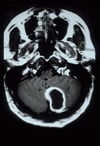 Absceso cerebeloso