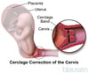 Cervical Cerclage