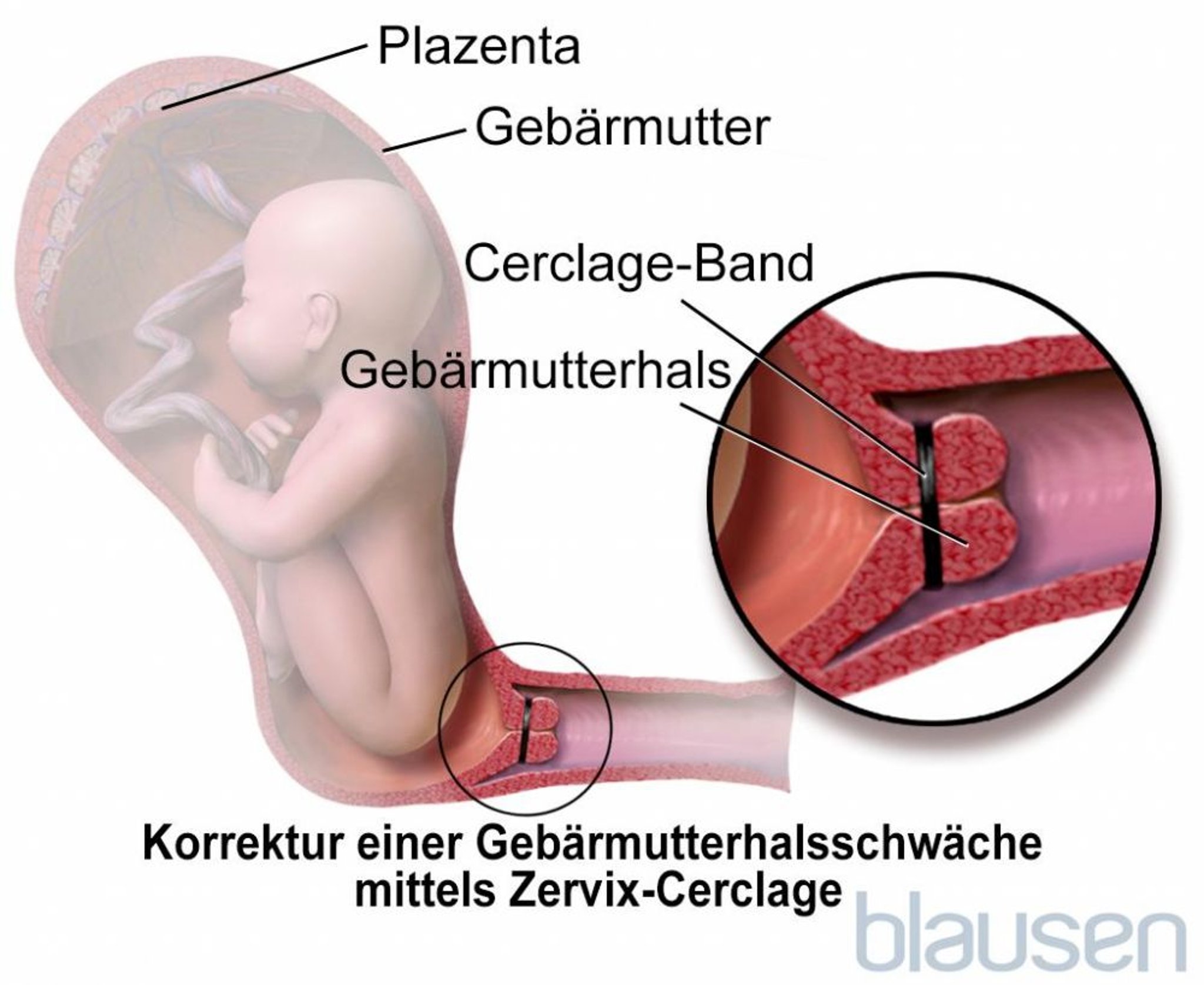Zervikale Cerclage