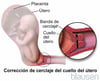Cerclaje cervical