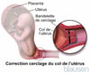 Cerclage cervical