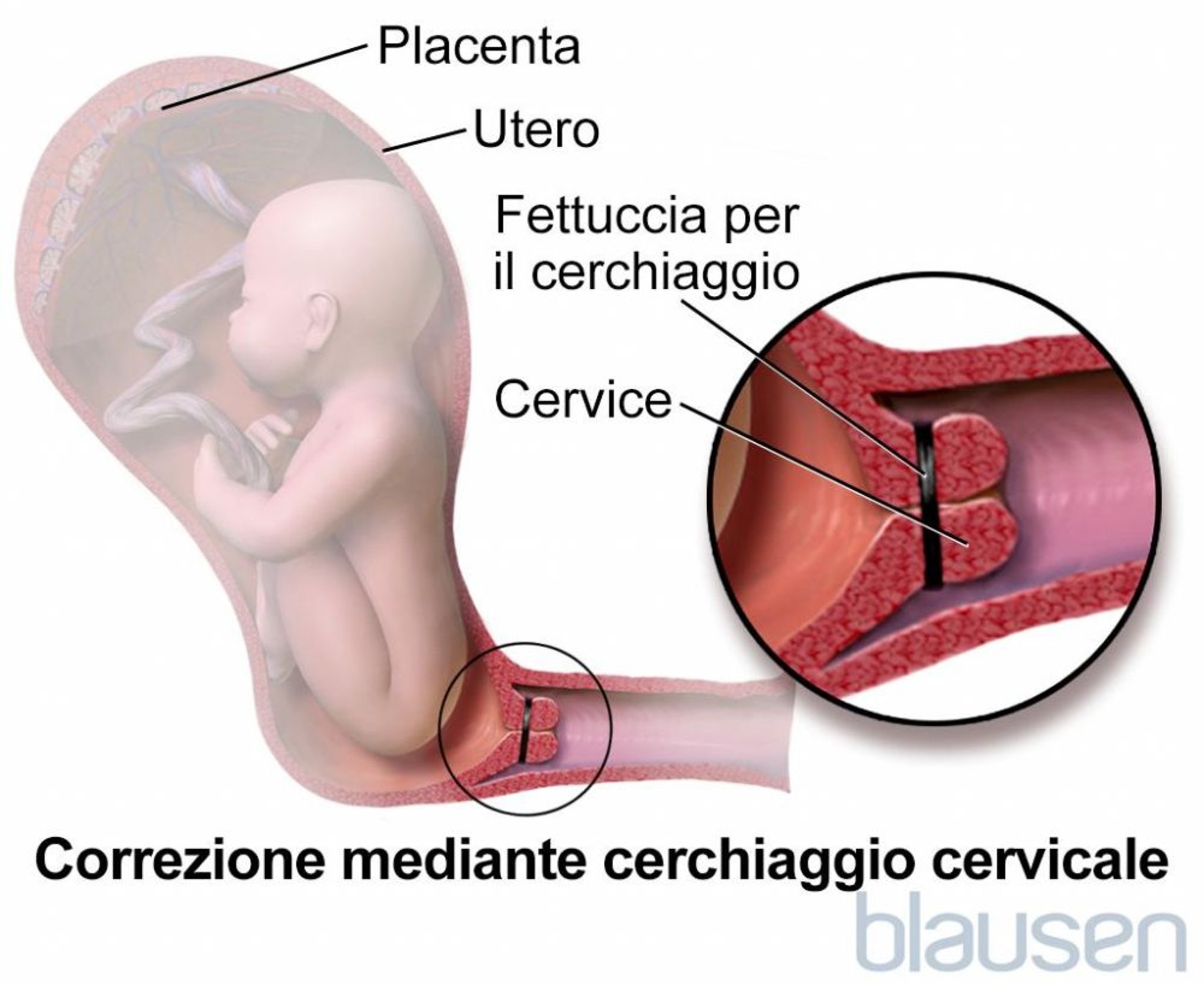 Cerchiaggio cervicale