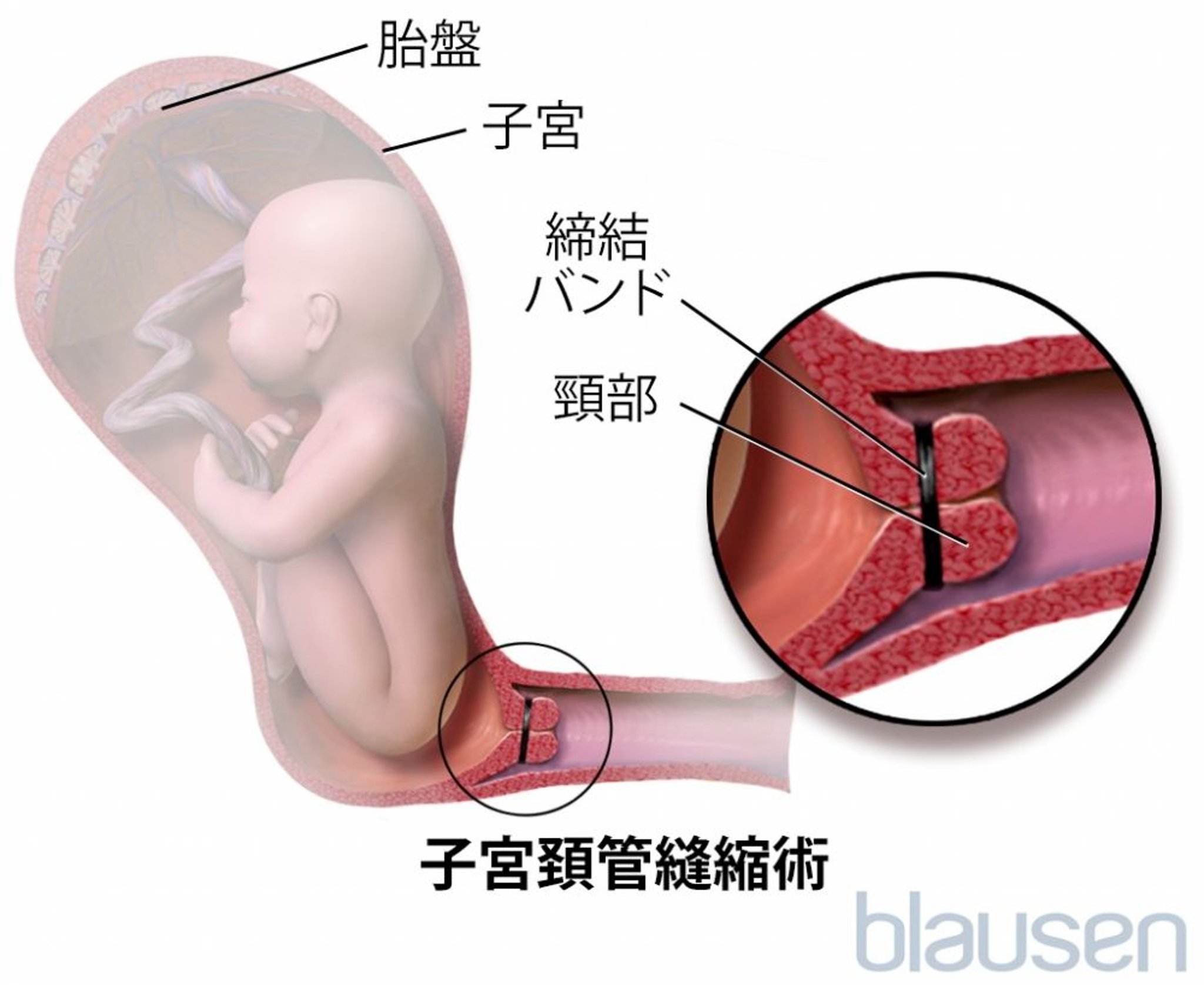子宮頸管縫縮術