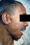 Cervicofacial Actinomycosis