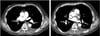 Embolia pulmonar (angiografía por TC torácica)