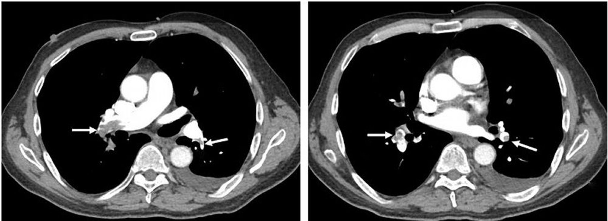 Embolia pulmonar (angiografía por TC torácica)