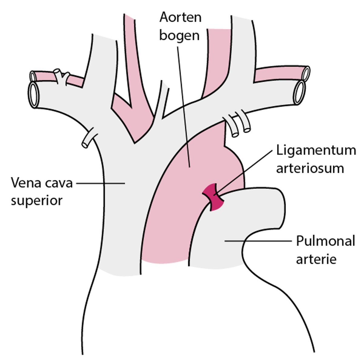 Die meisten Teilrisse der Aorta treten in der Nähe des Ligamentum arteriosum auf