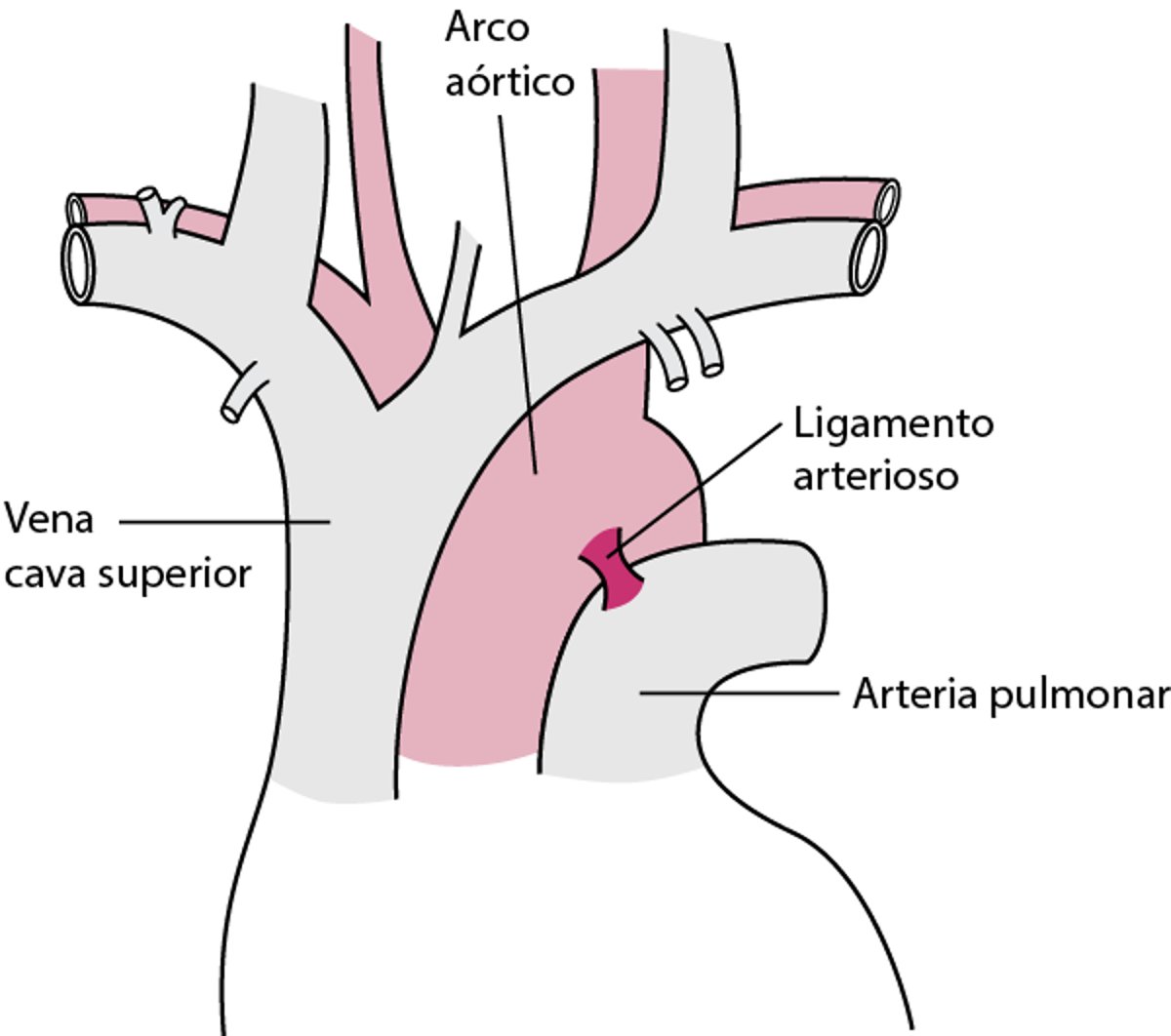 La mayoría de las roturas parciales de la aorta se producen cerca del ligamento arterioso