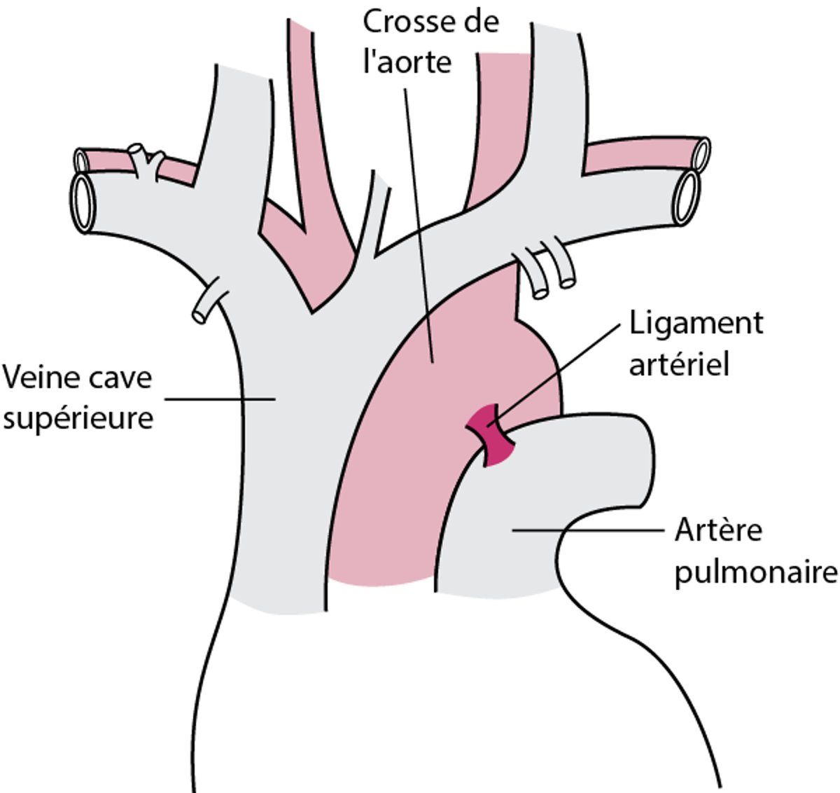 La plupart des ruptures partielles de l'aorte se produisent près du ligament artériel