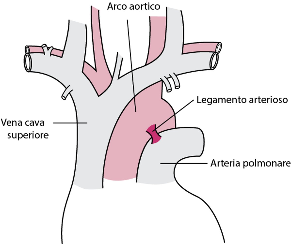 La maggior parte delle rotture parziali dell'aorta si verifica in prossimità del legamento arterioso