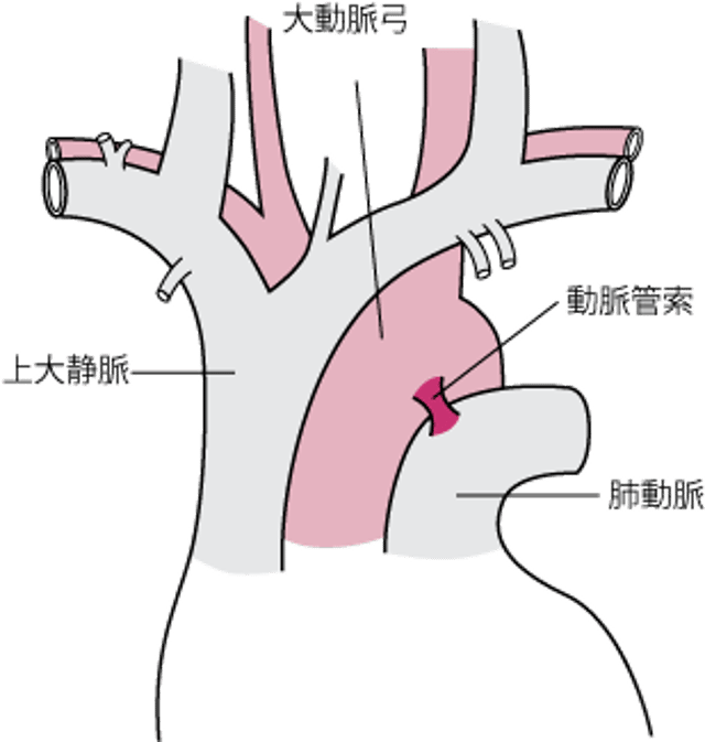 大動脈の部分破裂のほとんどは動脈管索の近くで起こる